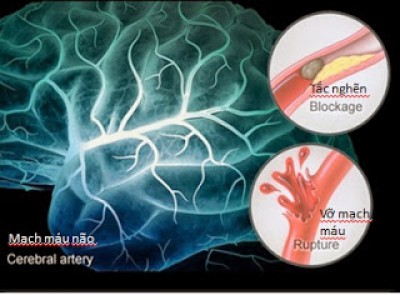 Những bài thuốc dân gian phòng ngừa tai biến mạch máu não